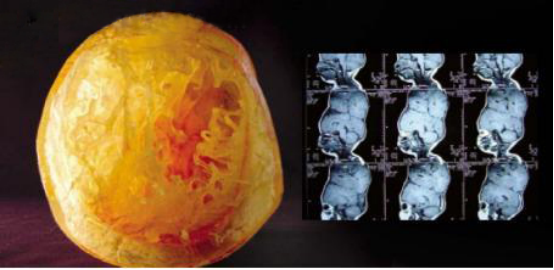 3D´òÓ¡ÊÖÒÕÔÚÒ½ÁÆÐÐÒµÖеÄÓ¦ÓÃÇéÐÎ 3D´òÓ¡ÊÖÒÕÔÚÒ½ÁÆÐÐÒµÖеÄÓ¦ÓÃÇéÐÎ